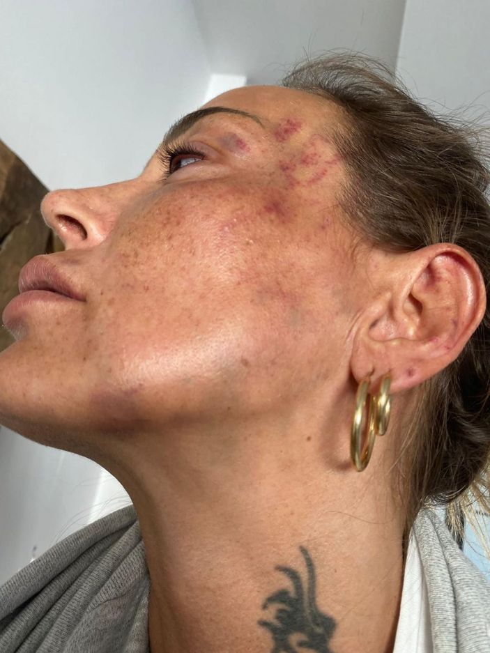 d Bursa'da eski sevgiliye dayağa 12 yıl hapis istemi