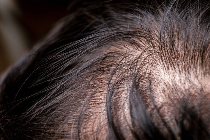 Anormal saç dökülmesinin 5 nedeni