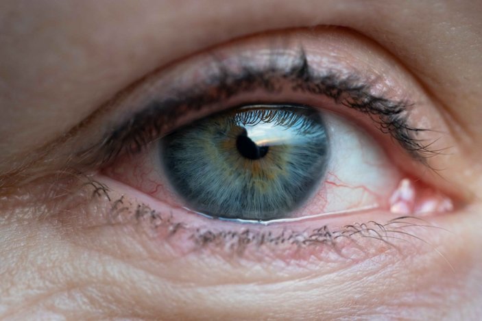 Kuru göz sendromu neden oluşur ve nasıl tedavi edilir