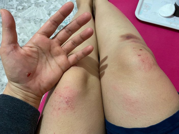 Malatya’da işe giderken köpeklerin saldırdığı kadın yaralandı