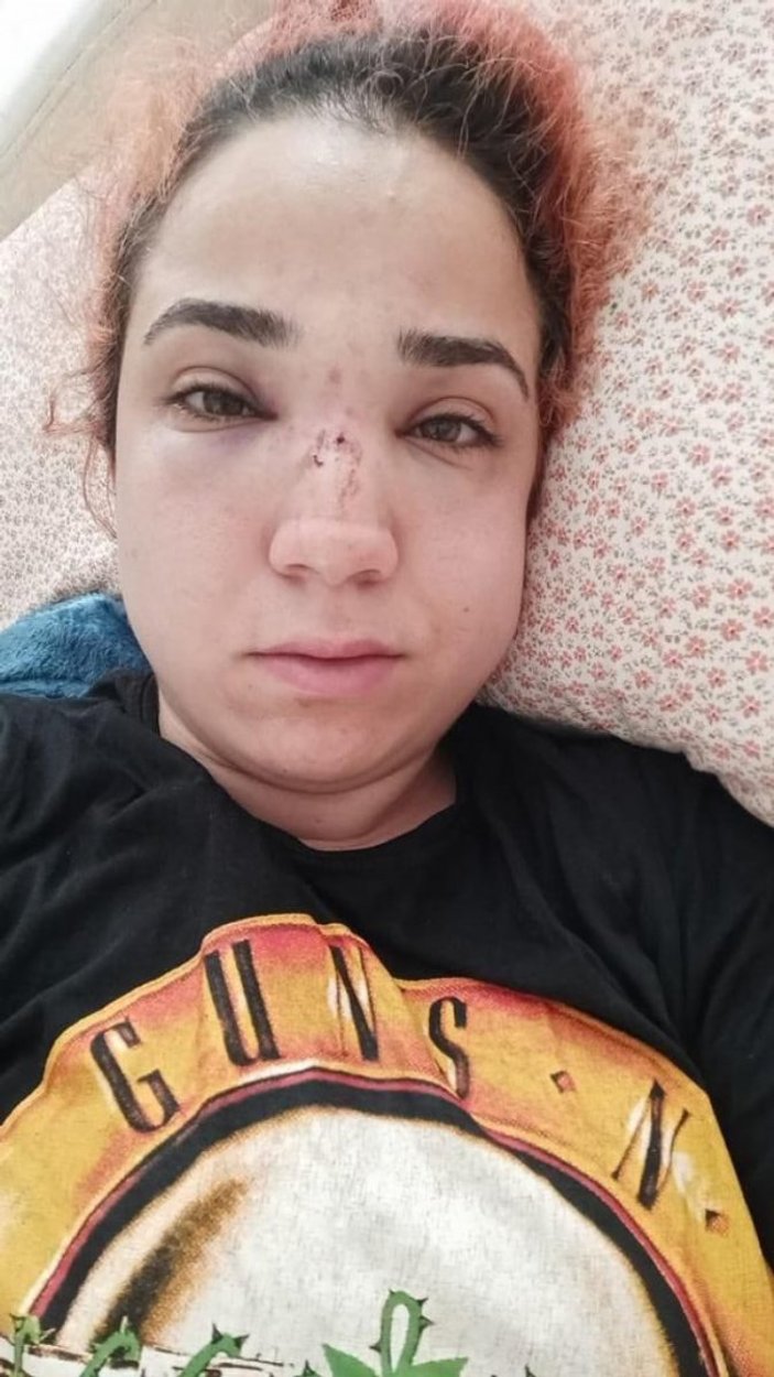 İzmir’de, işvereni tarafından burnu kırıldı