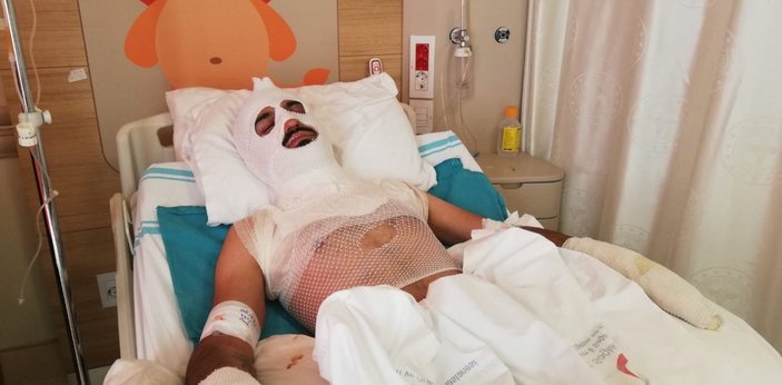 Erzincan'da tiner ile ateş yakmak isteyen gencin yüzü yandı