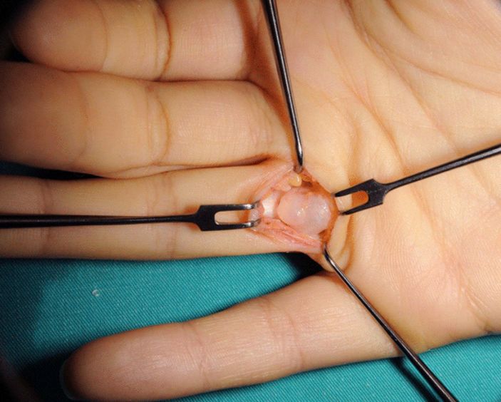 El bileğinizi kontrol edin: Ganglion kisti nedir, nasıl anlaşılır?