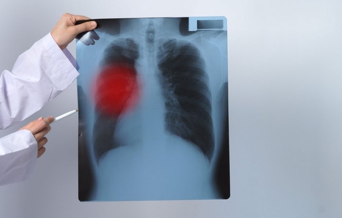Akciğer kanserinin en önemli 10 belirtisi