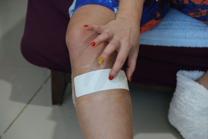 Antalya’da sokak köpeği tarafından ısırılan aşçı kadın kabusu yaşadı