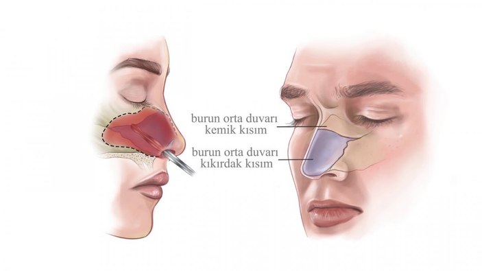 Septoplasti nedir