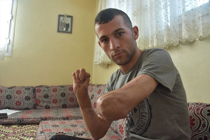a Adanalı genç, protez desteği bekliyor