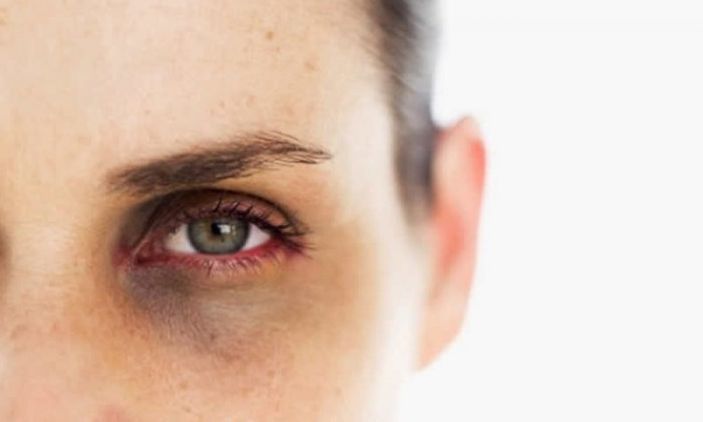 Göz altlarımız neden morarır? Sebebi o pigmentte gizli...