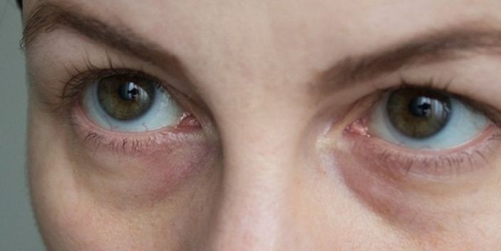 Göz altlarımız neden morarır? Sebebi o pigmentte gizli...