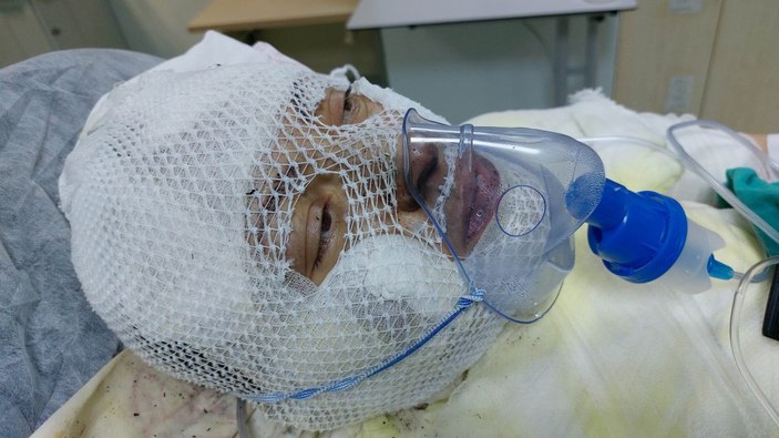 Ordu'da, eski eşini yanıcı maddeyle yakan adam: Borç verdim geri vermedi
