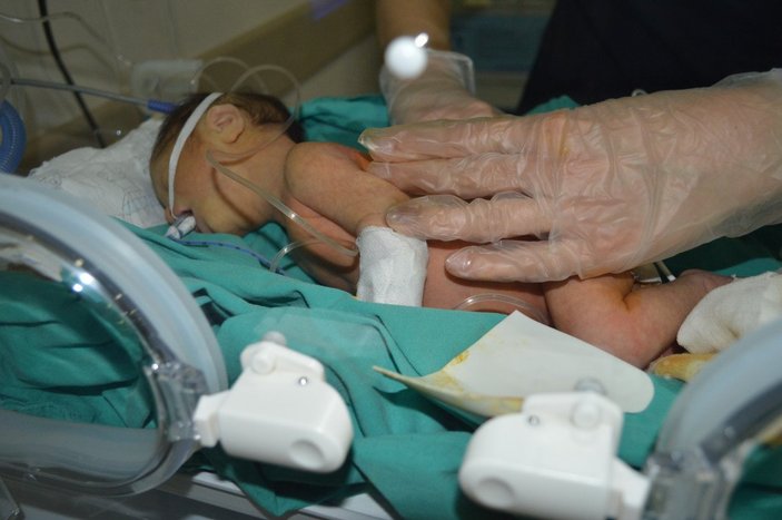 Erzincan’da, makatsız bebeğe 2,5 saatte makat yapıldı