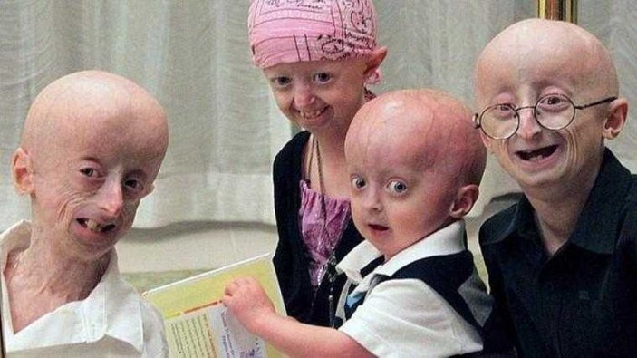 Progeria nedir