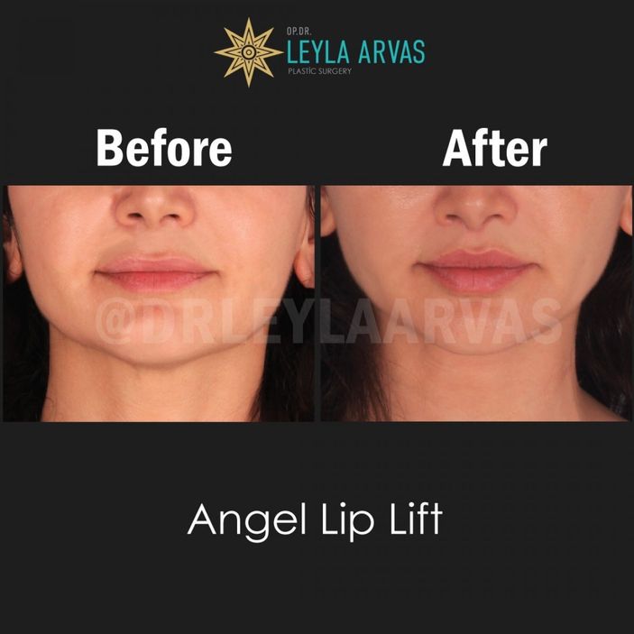 Dudakların mükemmelini yakalayan ikili! Size hangi dudak dokunuşu uygun Liplift mi Dudak dolgusu mu?