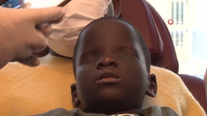 Afrika’da üvey annesi tarafından yüzüne asit dökülen çocuk, tedavi için Türkiye’de