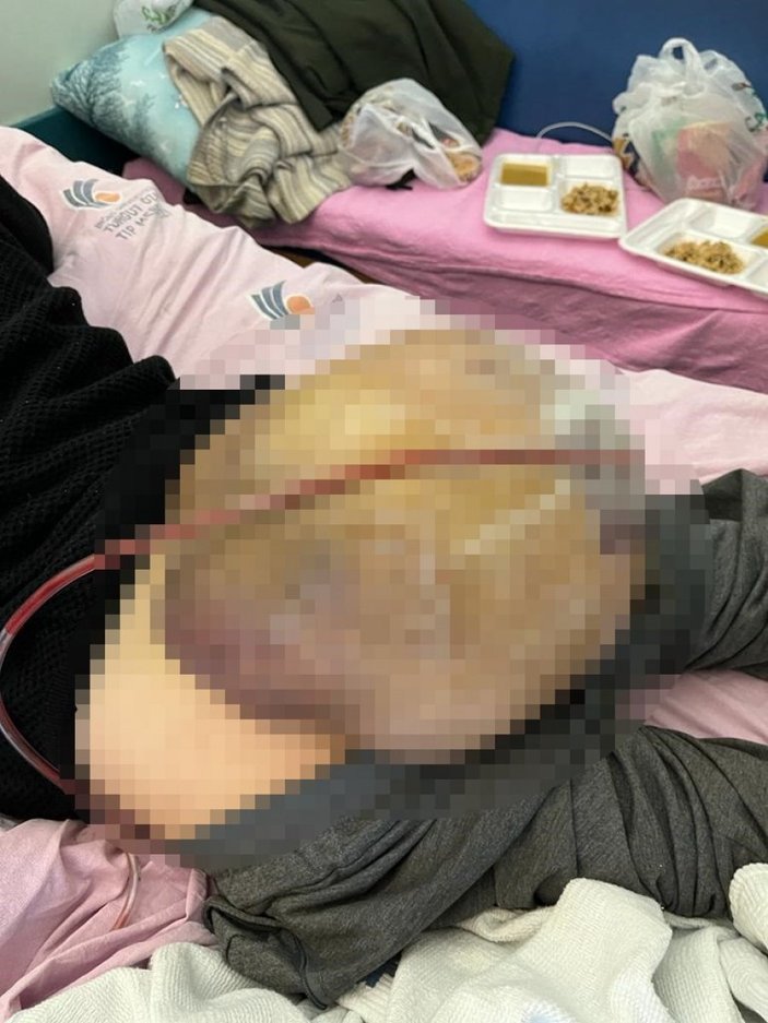 Şanlıurfa'da hastanın kalçasından 10 kilo tümör çıktı