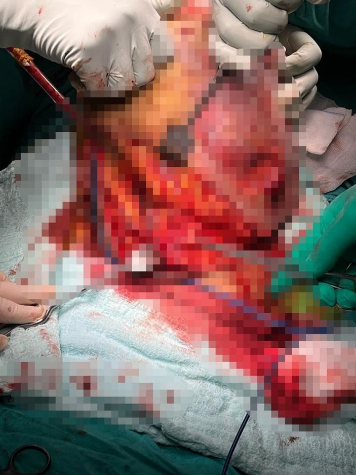 Şanlıurfa'da hastanın kalçasından 10 kilo tümör çıktı