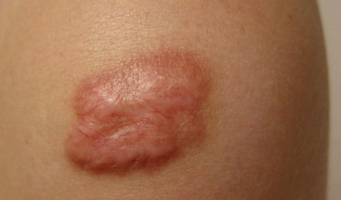 Keloid nedir