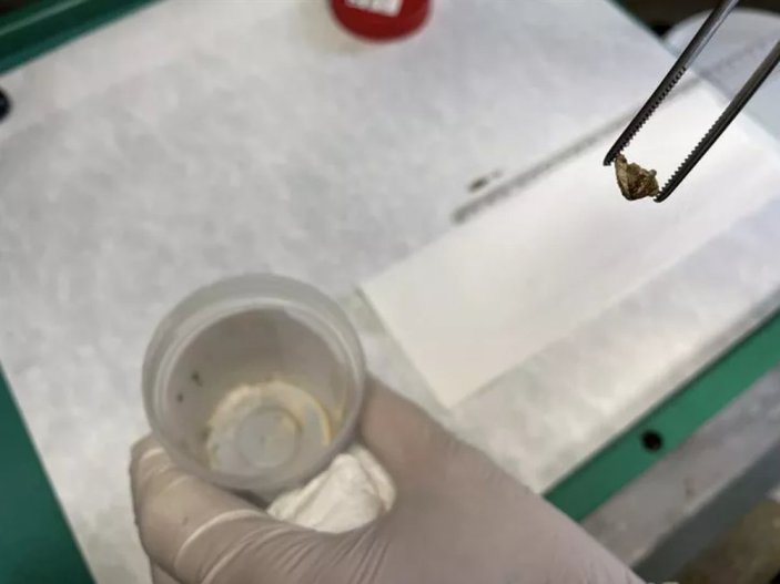 İzmir'de kanser zannedilen hastanın soluk borusundan badem kabuğu çıktı