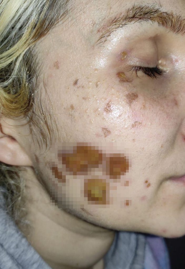 Ankara’da, kadının yüzüne kimyasal madde atan şahsın ev hapsi kaldırıldı