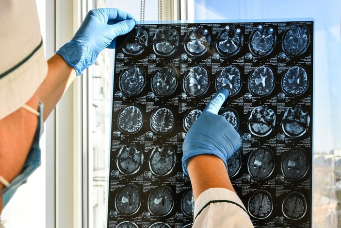 Beyin tümörünün bulunduğu yere göre 20 belirtisi