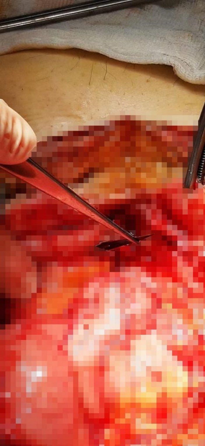 Ankara’da bir kadının midesinden 2 adet neşter çıkarıldı