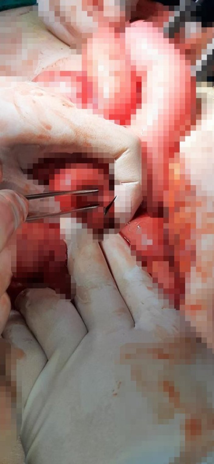 Ankara’da bir kadının midesinden 2 adet neşter çıkarıldı