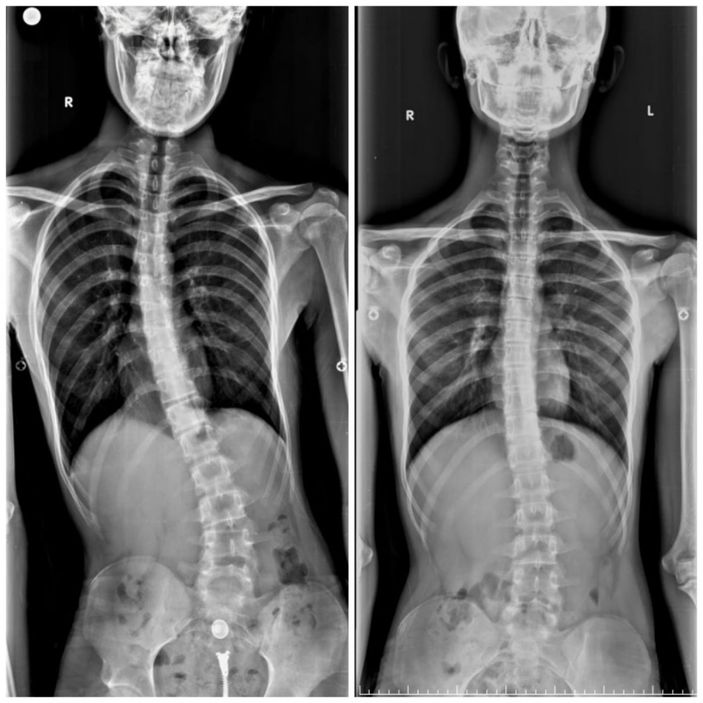 i Sakarya'da, bisiklet kazasıyla kemiklerindeki eğriliği fark etti
