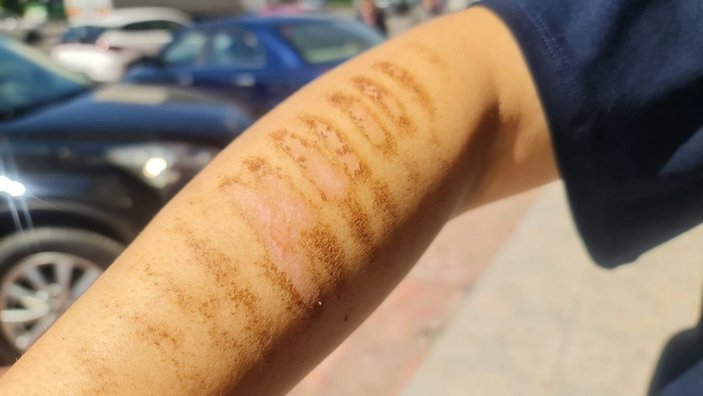 İzmit’te epilasyon sonrası kolları yandı