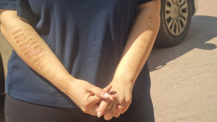 İzmit’te epilasyon sonrası kolları yandı