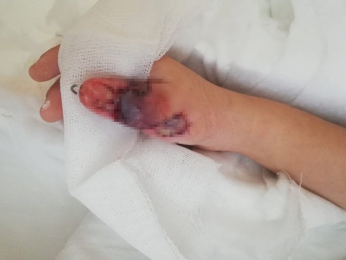 Kadıköy'de MR çekiminde küçük çocuğun eli, kemiğe kadar yandı
