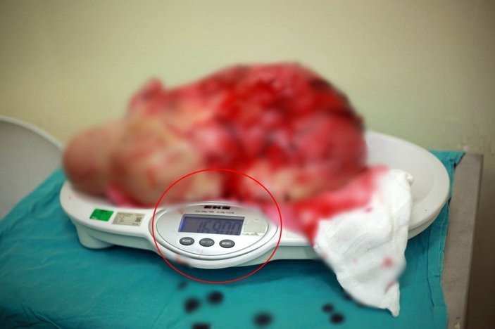 Samsun'da hastanın karnından 16,9 kiloluk dev kitle çıktı