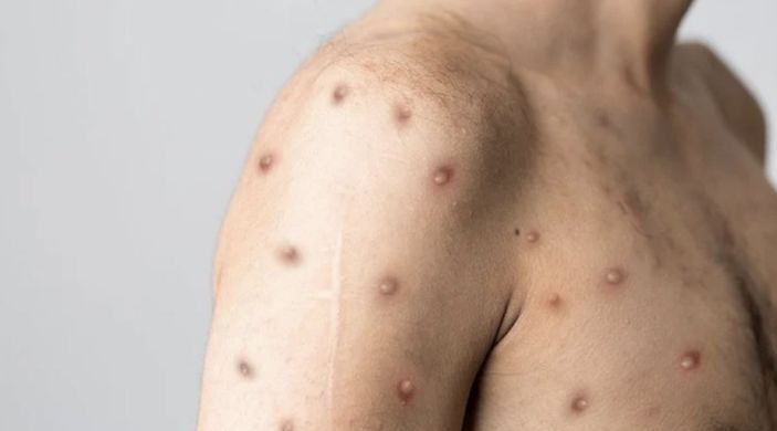 i Maymun çiçeği virüsünün ismi ırkçılık riskinden dolayı değiştiriliyor