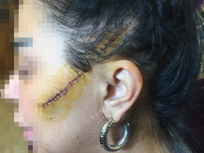 Adana'da, eski sevgilisinin yüzünü ustura ile kesti, 6 yıl hapis cezası aldı