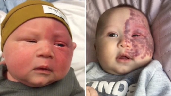 6 aylık bebeğe tepki çeken lazer tedavisi