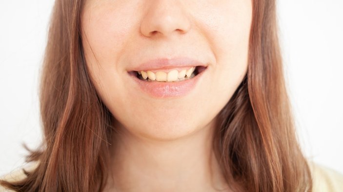 Diş beyazlatmak için 5 doğal yöntem