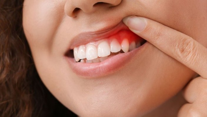 Diş eti iltihabına iyi gelen 3 mucizevi öneri