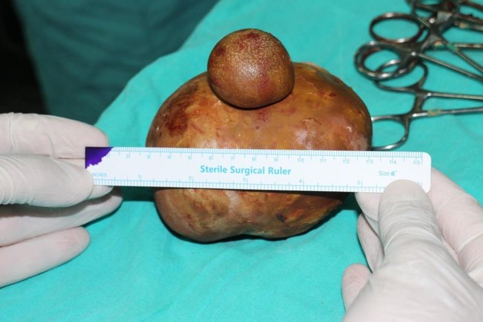 Karaman'da hastaneye başvuran hastanın mesanesinden 1 kilo taş çıktı