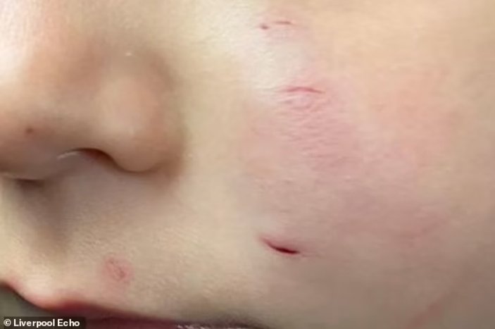 İngiltere'de 2 yaşındaki çocuğun yüzünü fare ısırdı