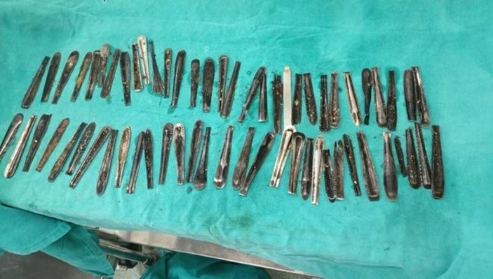 Hindistan’da bir adamın midesinden 63 kaşık çıkartıldı