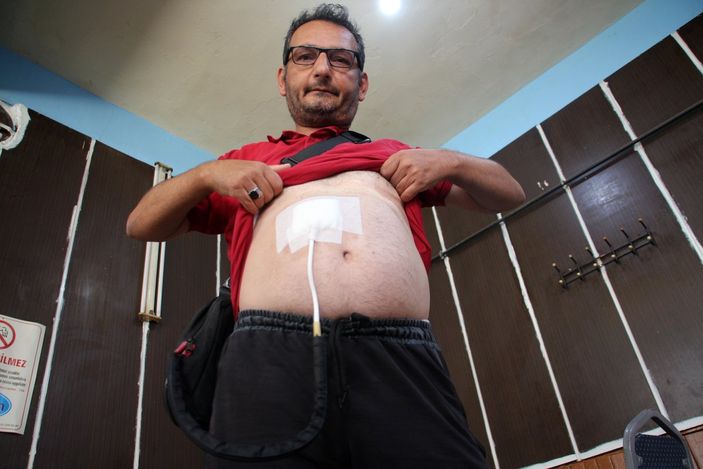 i Sivas'ta yapay kalple yaşayan adam: Çantamı para dolu zannediyorlar