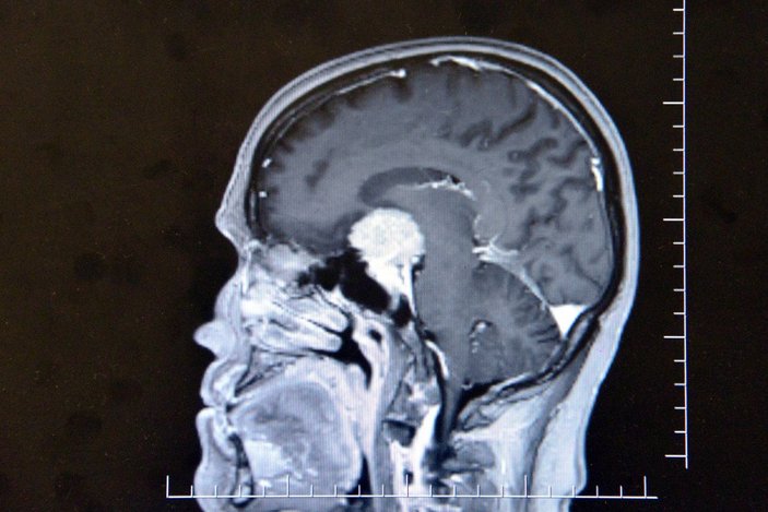 Kahramanmaraş'ta, beyninde milyonda bir görülen tümör çıkan kadın sağlığına kavuştu