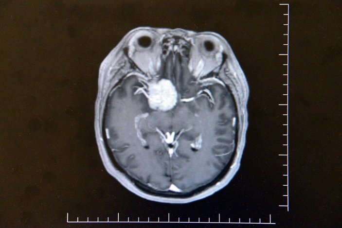 Kahramanmaraş'ta, beyninde milyonda bir görülen tümör çıkan kadın sağlığına kavuştu