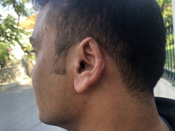 Büyükada'daki kavgada kopan kulağını martı kapmıştı: Mahkemeye çıktı