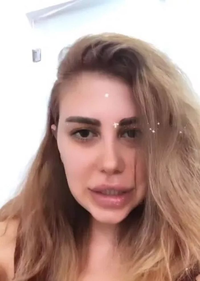 Kısmetse Olur'un Melis'i tanınmaz halde! Fenomen ismi son estetiklerden sonra gören tanıyamıyor