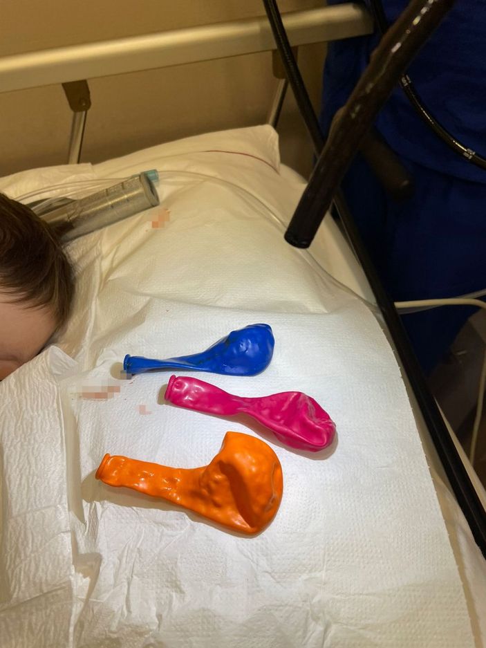 Gaziantep'teki 1 yaşındaki bebeğin midesinden 3 adet balon çıktı