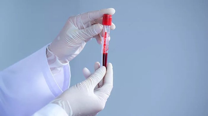 En tehlikeli kan grubu hangisidir? Bu kan grubundaki kişiler dikkat: Felç olma riski yüksek!