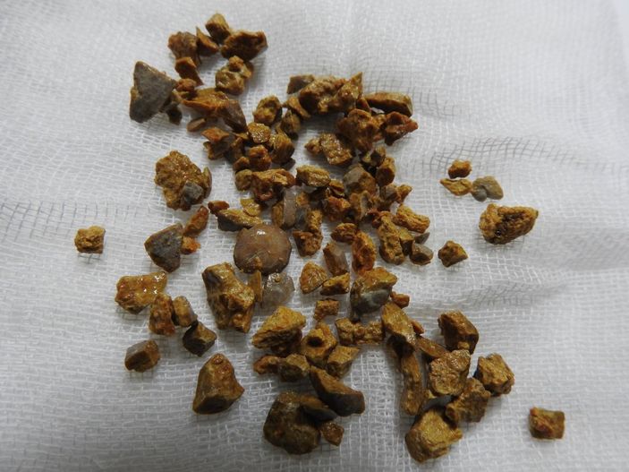 Çanakkale’de kadının böbreğindeki taş, 100 parçaya ayrılarak çıkarıldı