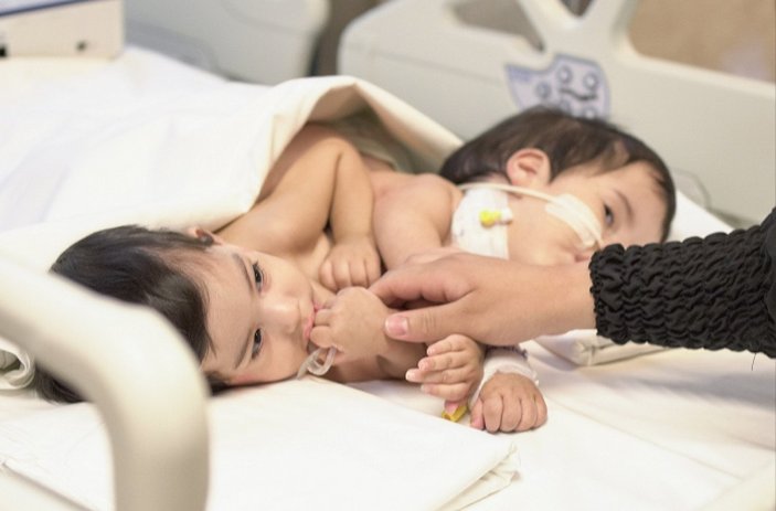 Ameliyatla ayrılan siyam ikizleri, taburcu edildi