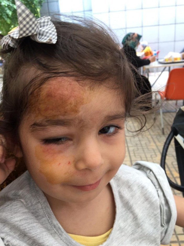 Bursa’da, kreşte düşen çocuğun alnında kırık oluştu