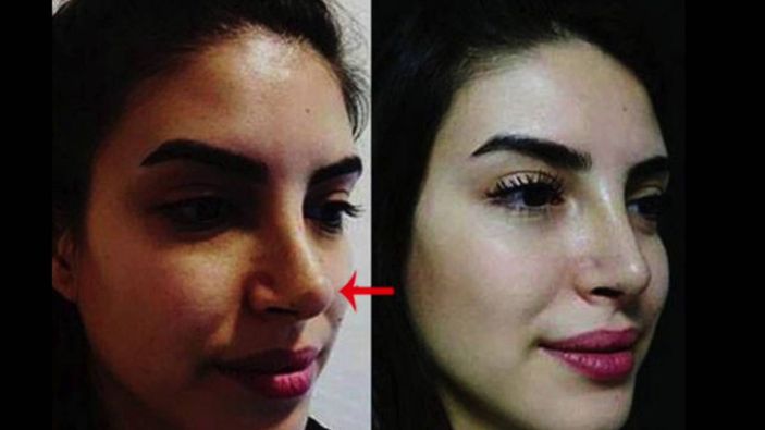 Teşkilat’ın Zehra’sı Deniz Baysal'ın eski hali şaşırttı! Meğer o da estetikli güzellerdenmiş